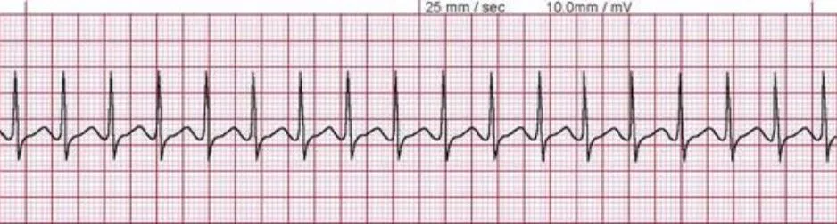 Supraventricular Tachycardia