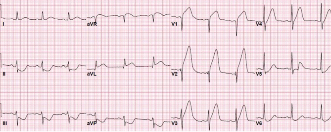 7 anterior stemi