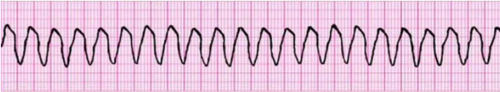 PALS 4 unstable wide complex tachycardia