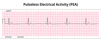 Pulseless Electrical Activity ECG Paper