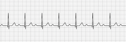 1st degree AV block wave 1st degree AV block