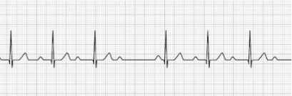 2nd degree AV block Type I 2nd degree AV block Type I (Mobitz Type I, Wenckebach’s)