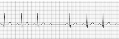 2nd degree AV block Type II 2nd degree AV block Type II (Mobitz Type II)
