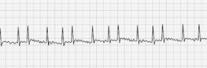 Atrial Fibrillation Atrial Fibrillation (aFib)