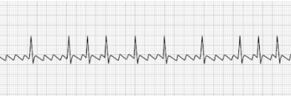 Atrial Flutter Atrial Flutter