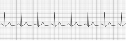 Normal Sinus Rhythm Wave Normal Sinus Rhythm (NSR)