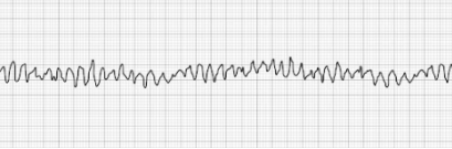 Pulseless Ventricular Fibrillation Pulseless Ventricular Fibrillation (vFib)