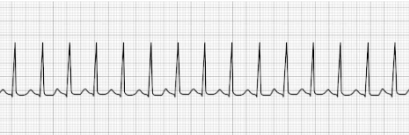 Supraventricular Tachycardia Supraventricular Tachycardia (SVT)
