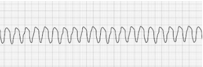 Ventricular Tachycardia Ventricular Tachycardia (vTach)