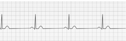 Sinus bradycardia wave Sinus Bradycardia