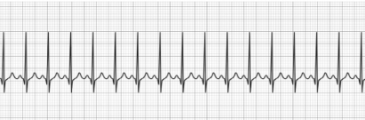 Sinus Tachycardia wave Sinus Tachycardia